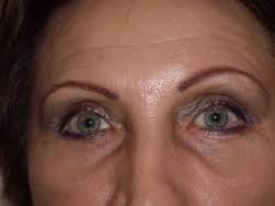 Medic primar, sef de lucrari, compententa chirurgie laparoscopica. Medlife Blefaroplastie Pret Despre ViaÈa Din Romania