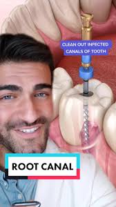 ROOT CANAL!? 🦷🤯 #PrimeDayDreamDeals #dentist #toothpain #rootcanal  #rootcanaltreatment #dentalhygienist #learnontiktok #teethwhitening  #learnontiktok