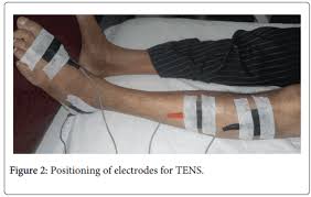 Andldquo Comparison Between Electrical Stimulation Over