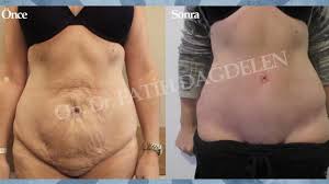 Karin Germe Ameliyati 2020 Youtube