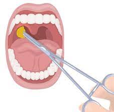 Cirurgia De Amigdala Em Crianca Amigdalectiomia Infantil