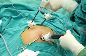 Laparoscopic Surgery | Minimally ...