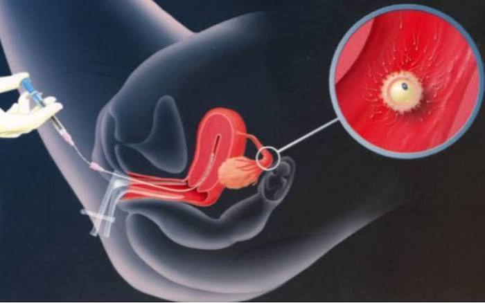 Quy tr&igrave;nh chuyển ph&ocirc;i v&agrave;o buồng tử cung với phương ph&aacute;p IVF