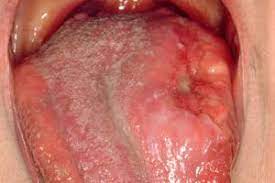 What can i do to prevent oral cancer? Mouth Cancer Oral Cancer Nidirect