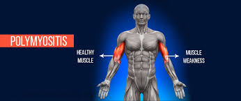 Image result for Polymyositis