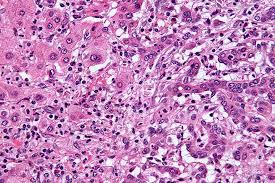 The grade is a way to rate how aggressive a tumor may behave. Cholangiocarcinoma Wikipedia