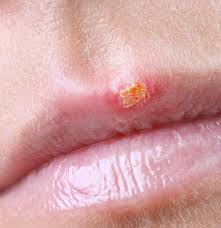 The increased number and higher efficiency of white. When Does A Cold Sore Stop Being Contagious