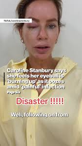 Caroline Stanbury is providing health updates via social media as she  battles a “painful” eye infection. 🫣