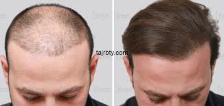زراعة الشعر في تركيا تجربتي تجربتي