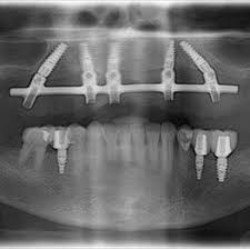 All On 4 Xray Oral Surgery Oral Surgeon Orthognathic Surgery