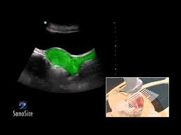 A pelvic ultrasound is the ideal imaging technique in pregnant women as it does not entail use of contrast or. 3d How To Female Pelvis Ultrasound Exam Sonosite Ultrasound Youtube