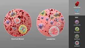 Image result for Leukemia