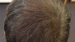 We can lose between 50 and 100 hairs a day, often without noticing. Hair Loss Treatment In Birmingham Hair Loss Clinic Birmingham Uk