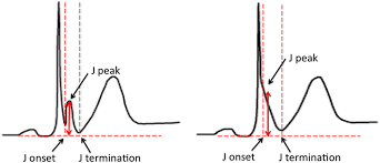 Image result for Early Repolarization