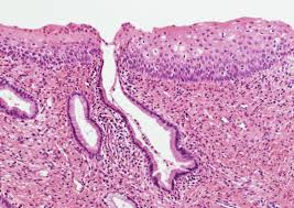 Low grade squamous intraepithelial lesion (lsil/cin 1). Pathology Outlines Squamous Metaplasia