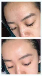 Ketoconazole works by preventing the fungus from making normal cell walls, thereby stopping fungal growth. Redditor Shares Transformative Fungal Acne Routine See Her Before After Photos Allure
