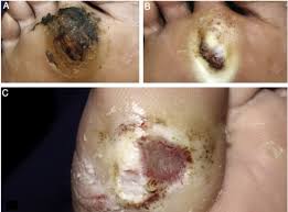 If the biopsy is not sufficiently deep and extensive, only cutaneous necrosis and an inflammatory infiltrate can be observed and may be confused with pyoderma gangrenosum. Consensus On The Diagnosis And Management Of Chronic Leg Ulcers Brazilian Society Of Dermatology Sciencedirect