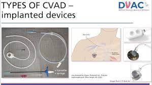 Image result for Difficult Intravenous Access in Children