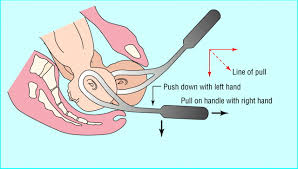 Patterson}, journal={canadian medical association journal}, volume={18 2}, pages={. Operative Delivery The Bmj