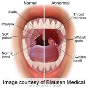 Signs and symptoms are ways the body lets you know that you have an injury, illness, or disease. Hpv Linked Throat Cancer May Have Telltale First Symptoms Webmd