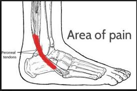 Forced ankle eversion and forced dorsiflexion with a contracted tibialis posterior tendon is the most common mechanism of tendon subluxation, though the phenomenon is also seen with medial malleolar fractures.medial flexor retinaculum injuries are also usually associated with deltoid ligament injuries. Peroneal Longus Tendon Tear Dr Hc Chang