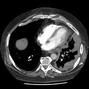 Early detection offers physicians a wider range of treatment options,. Mesothelioma Radiology Reference Article Radiopaedia Org