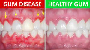 Gingivitis often resolves with good oral hygiene, such as longer and more frequent brushing, and in mild cases of gingivitis, patients may not even know they have it, because symptoms are mild. Gum Periodontal Disease Symptoms Treatment Shanti Dentals