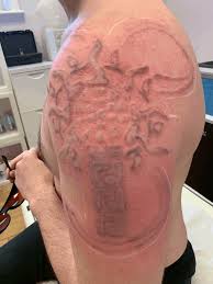 Check spelling or type a new query. Redness After Laser Tattoo Removal Laseryou Picosure Tattoo Removal Skin Rejuvenation Soprano Titanium Ice Hair Removal