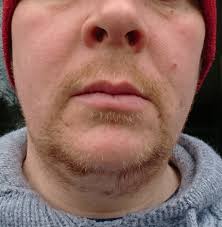 The reason it's more difficult to remove blonde hair through laser hair removal, and so, which laser systems will effectively remove blonde facial hair and body hair? Light Blond And Patchy First Attempt Beyond 2 Weeks Beard Board
