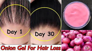 Nutritional factors and hair loss. clinical and experimental dermatology 27.5 (2002): Onion For Hair Growth Diy Onion Hair Gel Grow Long Strong Hair Treat Hair Fall Hair Loss Youtube