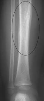 Meaning of spiral fracture medical term. Fractures