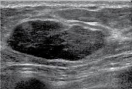 Learn more about the breast ultrasound the gel doesn't harm your skin or stain your clothes. Ultrasound Can Accurately Diagnose Fibroadenomas In Women Less Than 35 Years