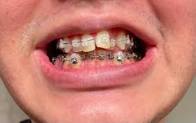 I'm getting the actual braces plus top expander this friday(in two days). 30 Years Old First Day Of Damon Braces With A Palate Expander And Turbo S On My Rear Molars It S Never Too Late This Sub Motivates Me I Can T Wait To See Progress