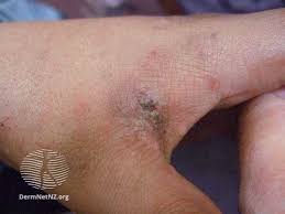 Image result for scabies on humans