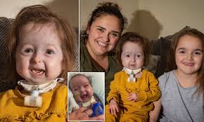 Girl Two Is The Only Person In The World To Have A Type Of Benjamin Button Disease Daily Mail Online
