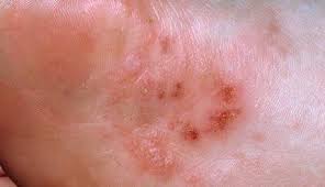 Image result for pompholyx soles of feet