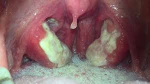 Sore Throat Treatment Causes Diagnosis Symptoms More