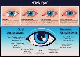 Image result for Bacterial Conjunctivitis