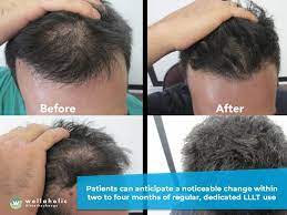 How is low level laser therapy supposed to work? Your Expert Guide To Laser Treatment For Hair Loss