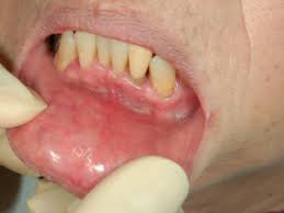 Oral Ulcerations Due To Drug Medications Sciencedirect
