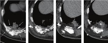 High risk stage 2 colon cancer patients are more likely to benefit from chemotherapy treatment generally, outcomes for cancer recurrences that are detected and treated in their earliest possible understand the signs & symptoms of colon cancer: 64 Year Old Male With Metastatic Colon Cancer With Prior Rf Ablation Of Download Scientific Diagram