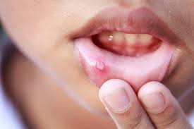 Image result for Lip Cancer