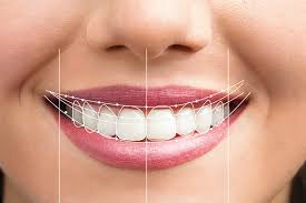 Smile Design In Eatons Hill | Emergency Dentiists In Eatons Hill