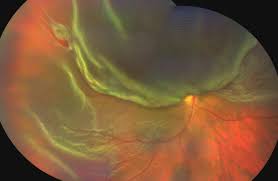 Image result for Retinal Detachment