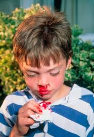 Banyak kejadian dapat menyebabkan hidung anak berdarah, yang sebagian besar tidak serius. Sarawak Aritok Doktor Kenapa Hidung Anak Saya Kerap Facebook