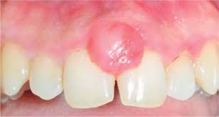 Image result for granuloma gum disease