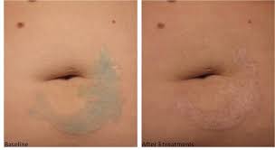Piqo4 capacity laser to treat a variety of skin conditions, including tattoo removal, its customers med spa trio offers an attractive range of. 71 Pico Laser For Tattoo Removal