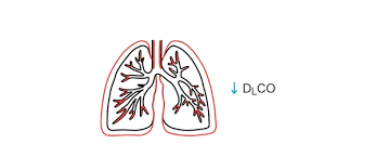 Image result for Diffusing Capacity