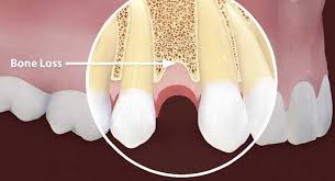 Learn facts about the difference between gingivitis and periodontitis. Bone Loss What Causes Low Jawbone Density