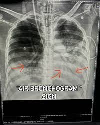 Image result for Air Bronchogram